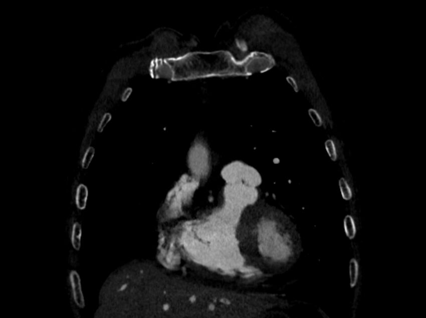 Chronic pulmonary embolism (Radiopaedia 91241-108843 A 17).jpg