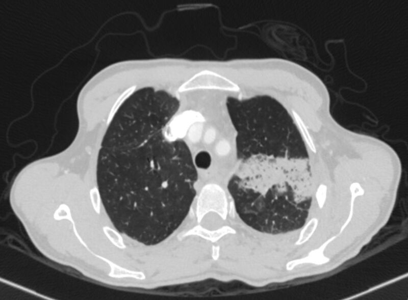 File:Chronic pulmonary embolism with bubbly consolidation (Radiopaedia 91248-108850 Axial lung window 33).jpg