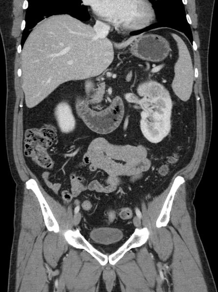 File:Clear cell renal cell carcinoma (Radiopaedia 61449-69393 F 12).jpg