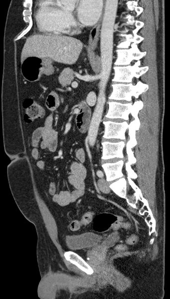 File:Clear cell renal cell carcinoma (Radiopaedia 61449-69393 G 51).jpg