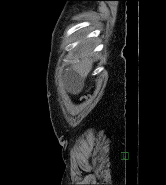 File:Closed-loop small bowel obstruction-internal hernia (Radiopaedia 78439-91096 C 130).jpg