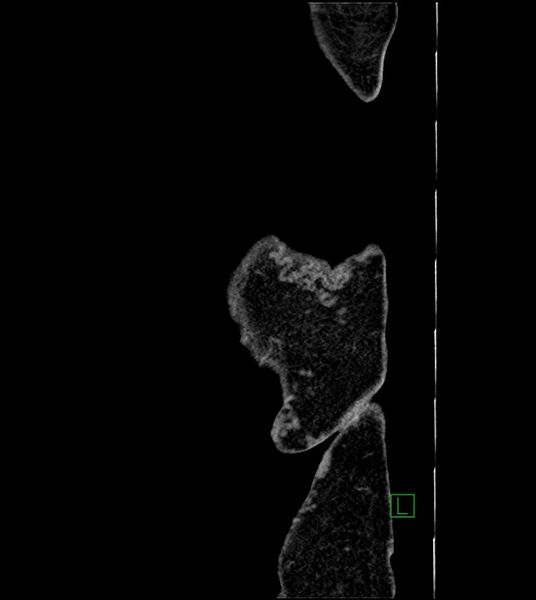 File:Closed-loop small bowel obstruction-internal hernia (Radiopaedia 78439-91096 C 5).jpg