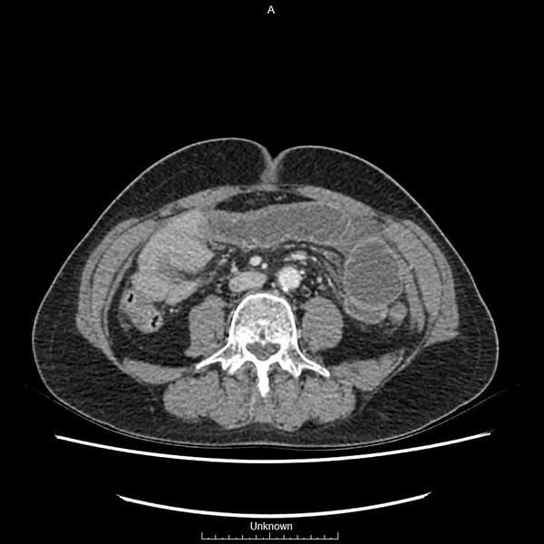 File:Closed loop bowel obstruction and ischemia (Radiopaedia 86959-103180 A 46).jpg