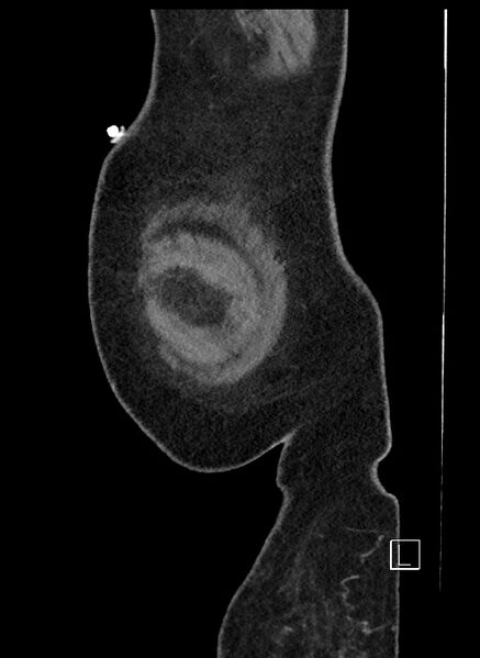 File:Closed loop obstruction - internal hernia into nephrectomy bed (Radiopaedia 59867-67320 C 111).jpg