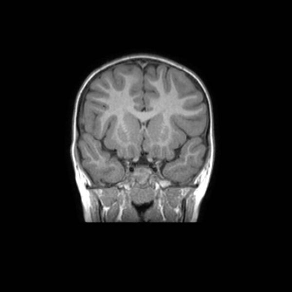 File:Cochlear nerve aplasia - unilateral (Radiopaedia 87910-104413 Coronal T1 20).jpg