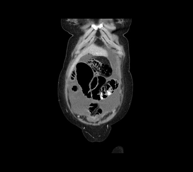 File:Cocoon abdomen with possible tubo-ovarian abscess (Radiopaedia 46235-50636 B 7).jpg