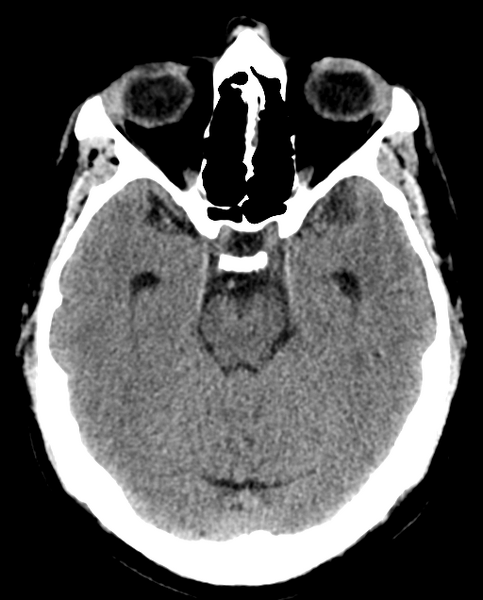 File:Colloid cyst of the third ventricle (Radiopaedia 86571-102661 Axial non-contrast 13).png