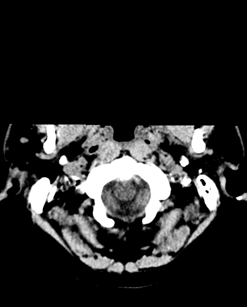 File:Colloid cyst of the third ventricle (Radiopaedia 86571-102661 Axial non-contrast 5).png