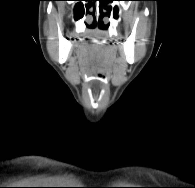 File:Colloid cyst of thyroid (Radiopaedia 22897-22923 Coronal C+ delayed 19).jpg