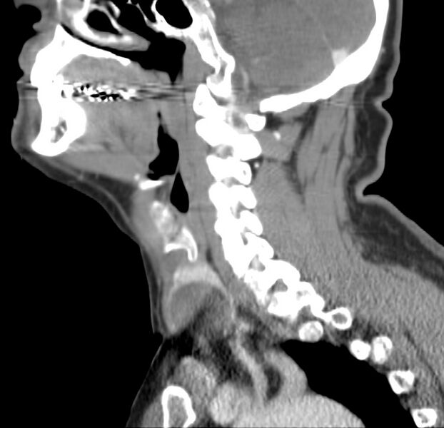 File:Colloid cyst of thyroid (Radiopaedia 22897-22923 Sagittal C+ delayed 35).jpg
