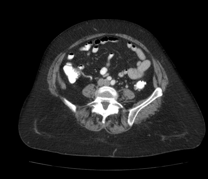 File:Colonic diverticulosis (Radiopaedia 22934-22957 A 47).jpg