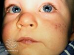 Infantile acne (DermNet NZ acne-infantile-acne2).jpg
