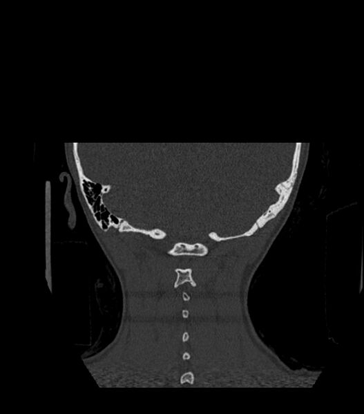 File:Nasoorbitoethmoid fracture (Radiopaedia 90044-107205 Coronal bone window 126).jpg