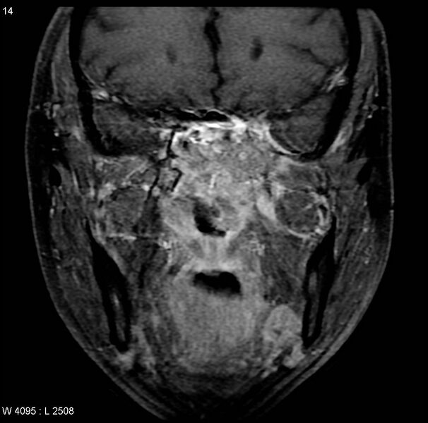 File:Nasopharyngeal carcinoma (Radiopaedia 4546-6667 E 4).jpg
