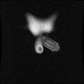 Necrotizing epididymo-orchitis with intra-testicular abscess (Radiopaedia 29397-29860 Coronal T1 C+ 3).jpg