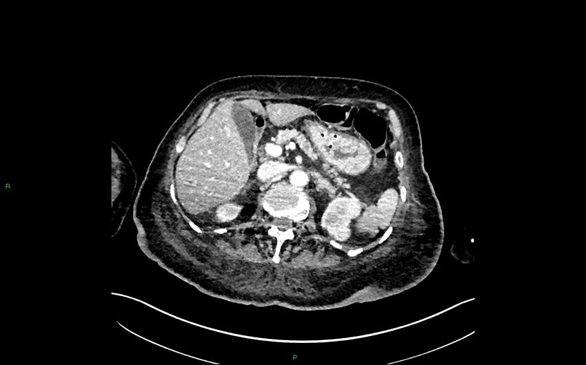 Neo-terminal ileal stricture (Crohn disease) (Radiopaedia 33790-34948 A 133).jpg