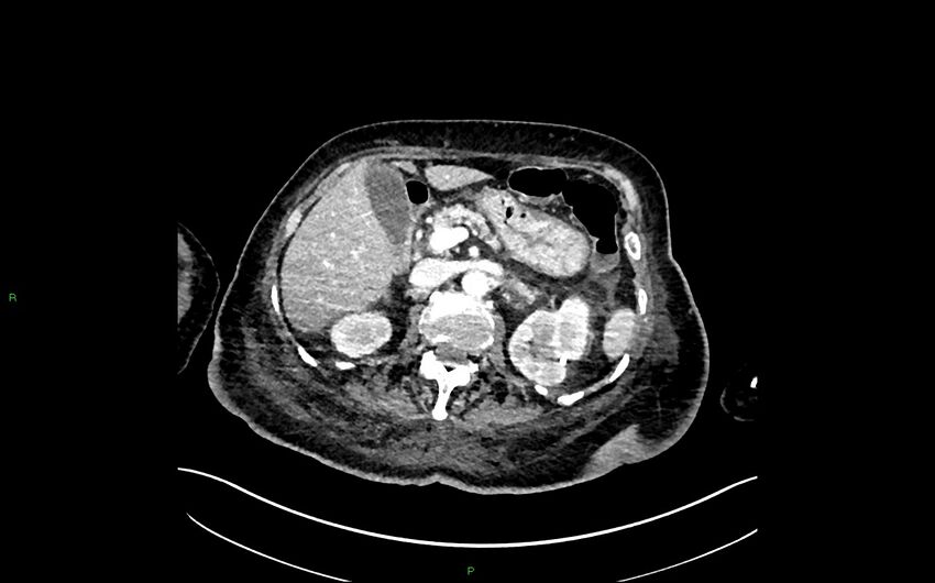Neo-terminal ileal stricture (Crohn disease) (Radiopaedia 33790-34948 A 140).jpg
