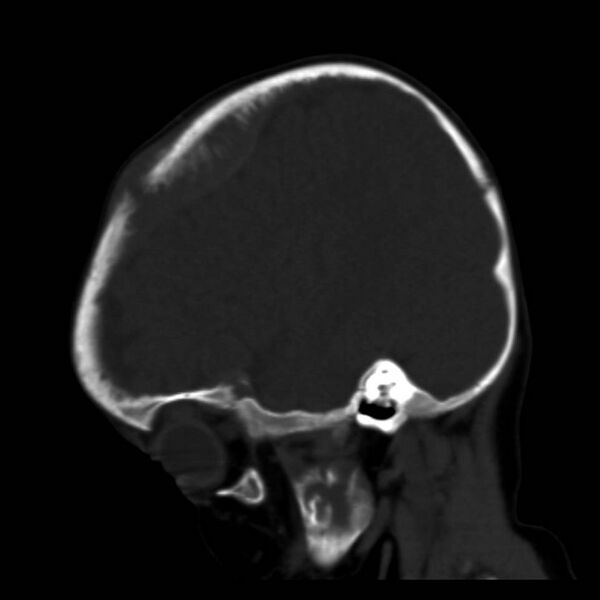 File:Neuroblastoma with skull metastases (Radiopaedia 30326-30958 Sagittal bone window 11).jpg