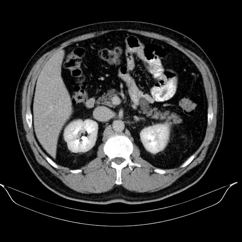 Neuroendocrine tumor of head of pancreas (Radiopaedia 57538-64502 D 31).jpg