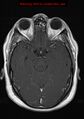 Neuroglial cyst (Radiopaedia 10713-11184 Axial T1 C+ 15).jpg