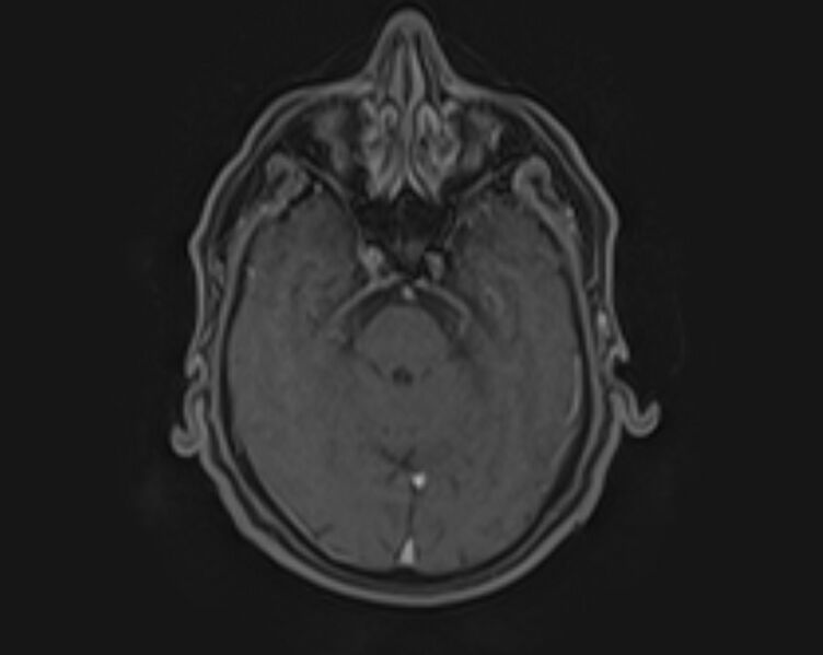 File:Non-Hodgkin lymphoma - parotid gland (Radiopaedia 71531-81890 E 24).jpg