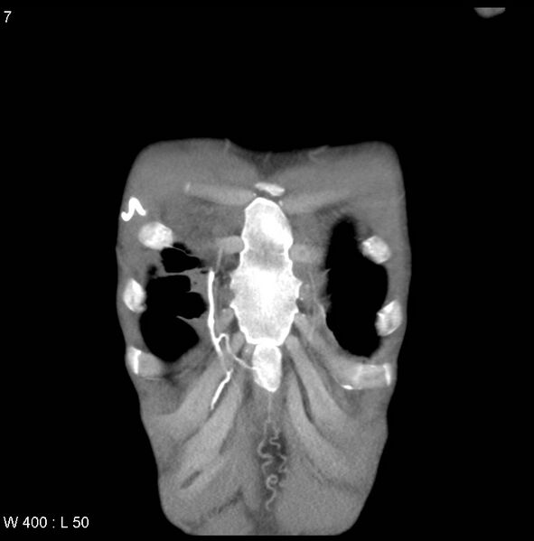 File:Non-Hodgkin lymphoma involving lung (Radiopaedia 29094-29470 C 1).jpg