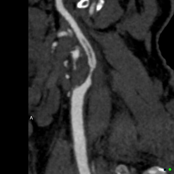 File:Non-occlusive intraluminal internal carotid artery thrombus (Radiopaedia 37751-39658 A 52).jpg
