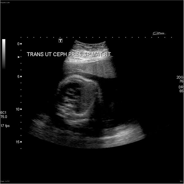 File:Normal 28 week gestation ultrasound in the context of blunt trauma (Radiopaedia 26231).jpg
