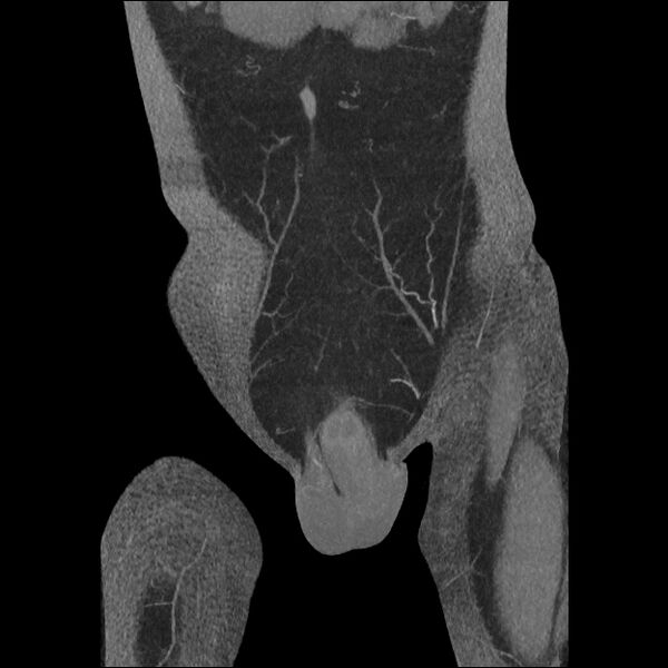 File:Normal CT angiogram of pelvis (Radiopaedia 45390-49430 B 10).jpg