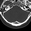 Normal CT of the cervical spine (Radiopaedia 53322-59305 Axial bone window 8).jpg