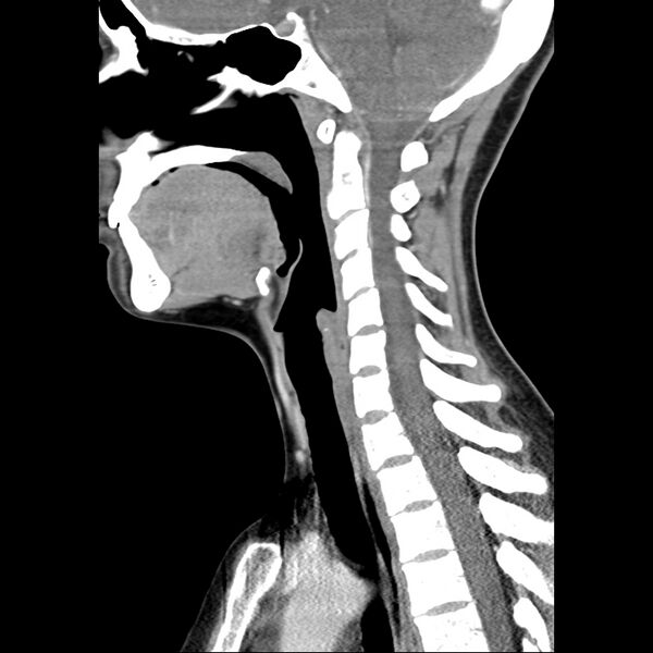 File:Normal CT of the neck (Radiopaedia 14575-14500 Sagittal C+ 28).jpg
