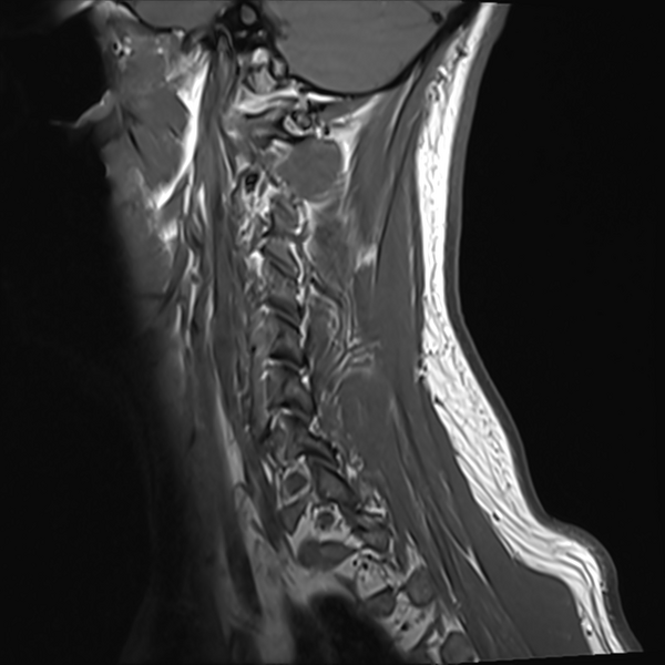 File:Normal MRI cervical spine (infection protocol) (Radiopaedia 53916-60039 Sagittal T1 1).png
