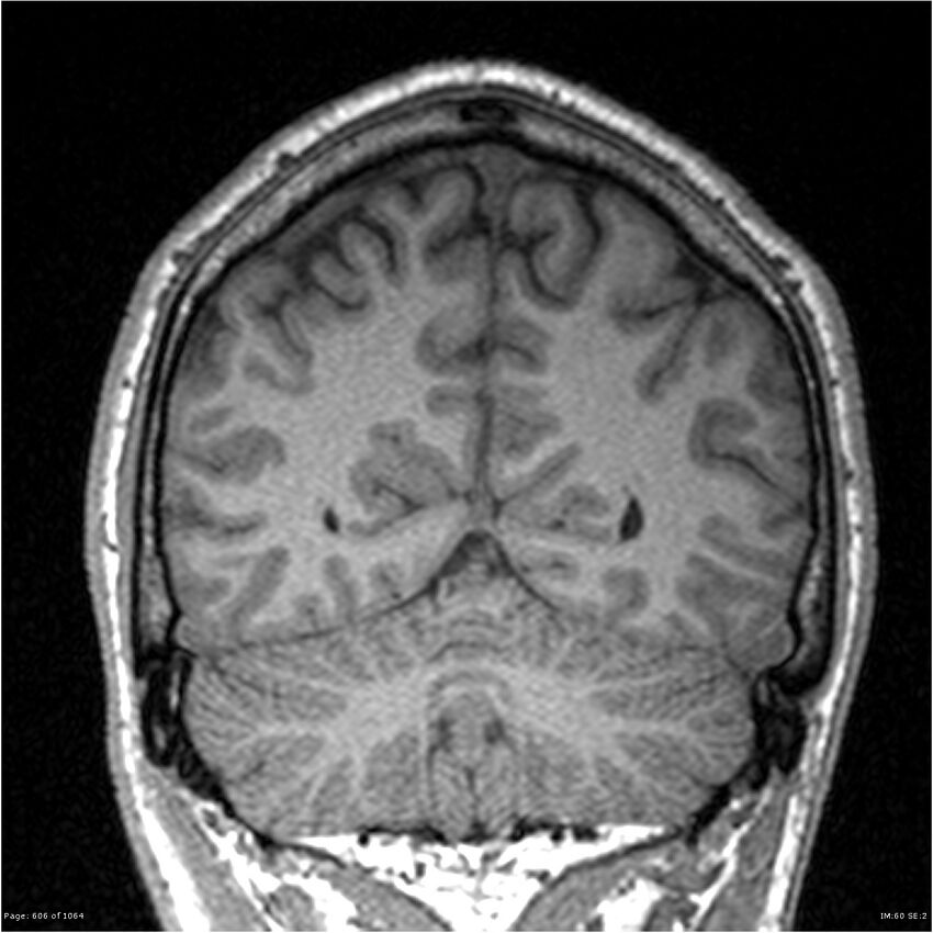 Normal brain MRI (non-focal epilepsy protocol) (Radiopaedia 38571-40700 Coronal T1 29).jpg
