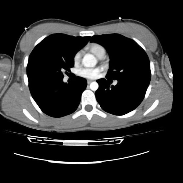 File:Normal dual-phase trauma CT chest,abdomen and pelvis (Radiopaedia 48092-52899 A 28).jpg