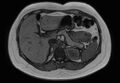 Normal liver MRI with Gadolinium (Radiopaedia 58913-66163 B 20).jpg