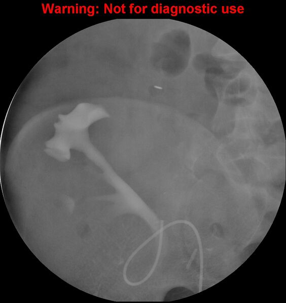 File:Normal retrograde pyelography of a native and transplant kidney (Radiopaedia 40480-43054 Transplant kidney 7).jpg