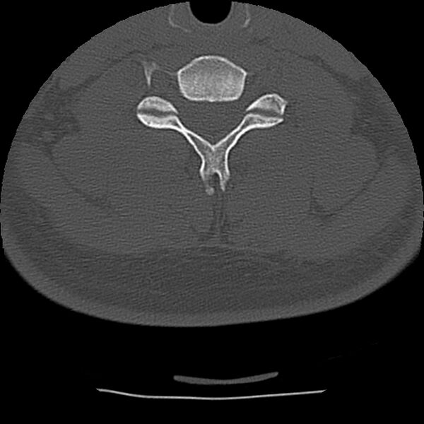 File:Normal trauma spine imaging (Radiopaedia 31753-32686 Axial bone window 59).jpg