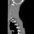 Normal trauma spine imaging (age 16) (Radiopaedia 45335-49358 C 6).jpg