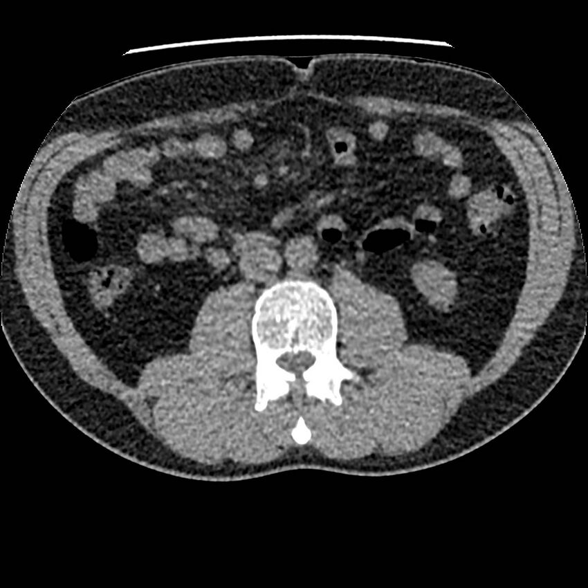 Obstructing ureteric calculus and ureteric anatomy (Radiopaedia 62730-71042 Axial non-contrast 64).jpg