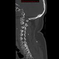 Occipital condyle fracture (Radiopaedia 18366-18208 Sagittal bone window 12).jpg