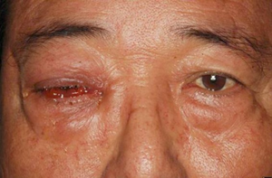 Adenoviral keratoconjunctivitis: periorbital swelling and ptosis, and severe chemosis