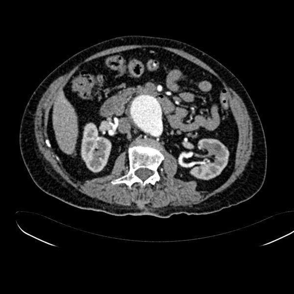 File:Abdominal aortic aneurysm (Radiopaedia 75131-86203 Axial C+ arterial phase 20).jpg
