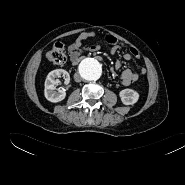File:Abdominal aortic aneurysm (Radiopaedia 75131-86203 Axial C+ arterial phase 24).jpg