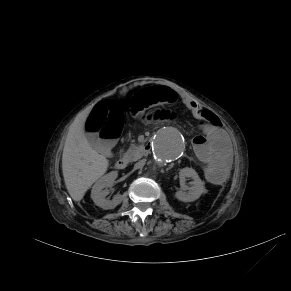 File:Abdominal aortic aneurysm - impending rupture (Radiopaedia 19233-19246 Axial non-contrast 55).jpg