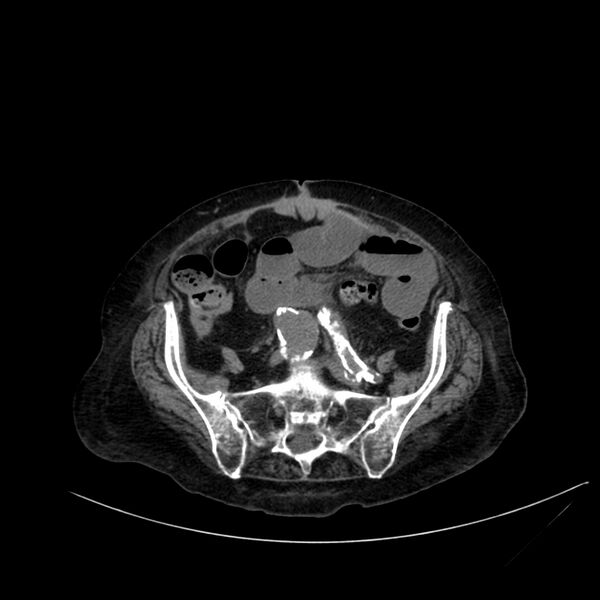 File:Abdominal aortic aneurysm - impending rupture (Radiopaedia 19233-19246 Axial non-contrast 92).jpg