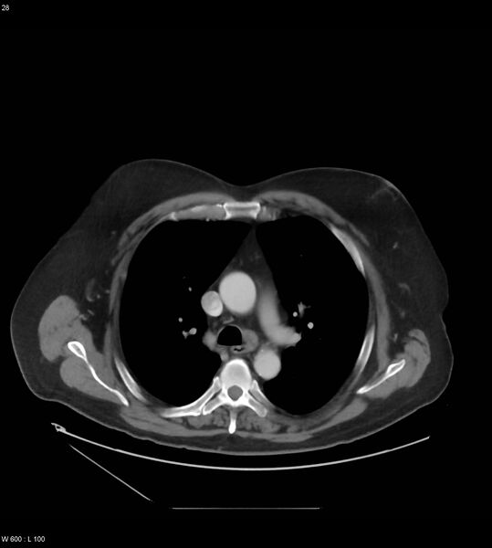 File:Abdominal aortic aneurysm with intramural hematoma then rupture (Radiopaedia 50278-55631 Axial C+ arterial phase 19).jpg