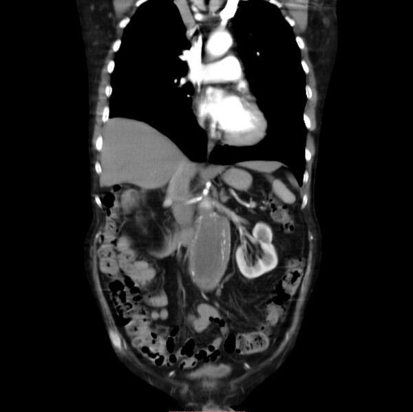 File:Abdominal aortic interposition tube graft and aneurysm thrombosis (Radiopaedia 71438-81857 Coronal C+ arterial phase 12).jpg