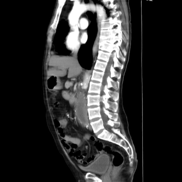 File:Abdominal aortic interposition tube graft and aneurysm thrombosis (Radiopaedia 71438-81857 Curved Sagittal C+ arterial phase 4).jpg