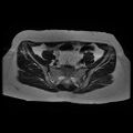 Abdominal wall endometriosis (Radiopaedia 83702-98847 Axial T2 4).jpg