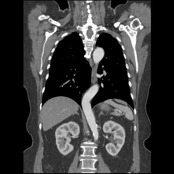 File:Aberrant right subclavian and left vertebral arteries (Radiopaedia 43467-46847 Coronal C+ portal venous phase 57).jpg